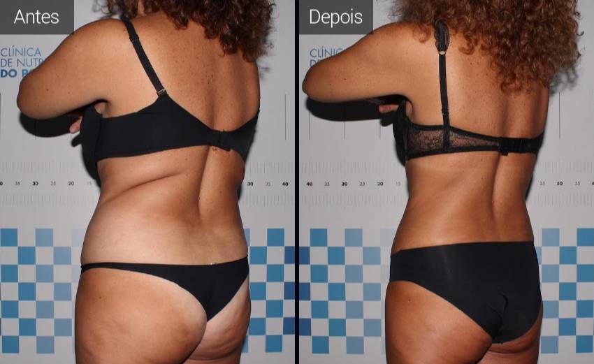 resultados - abdomen - flancos - costas - vista frontal